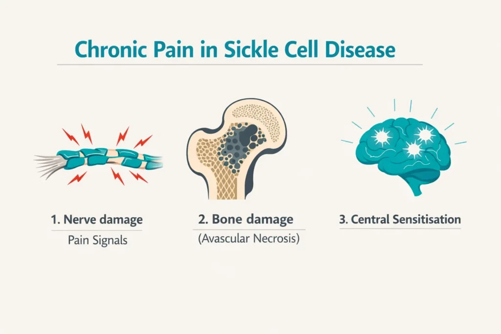 chronic pain sickle cell nerve damage avascular necrosis central sensitisation diagram